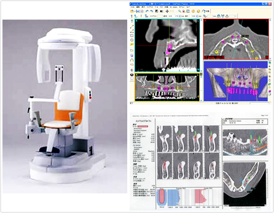 高性能歯科用マイクロCT